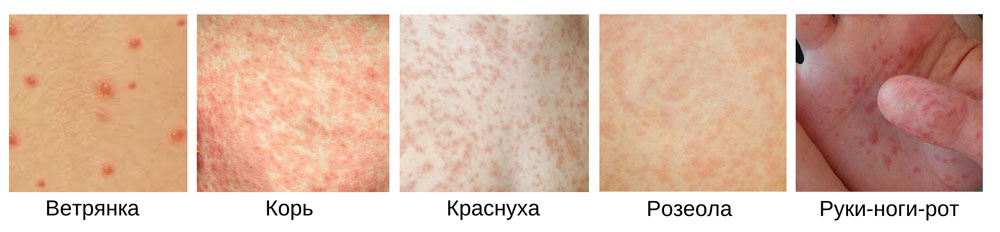 Что вызывает сыпь на стопах у ребенка?