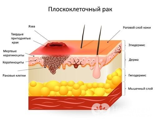 Болезнь Боуэна может трансформироваться в плоскоклеточный рак кожи