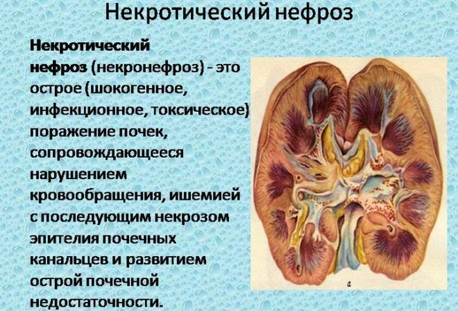 Некротический нефроз