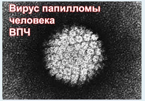 это вирус папилломы человека