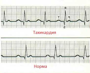 тахикардия
