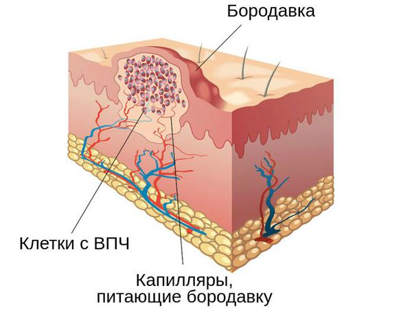 Анатомия бородавки