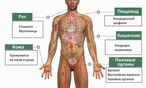 Зоны, подверженные инфицированию кандидозом