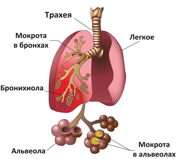 Пневмония