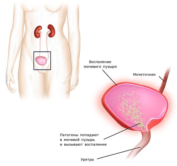 Острый цистит
