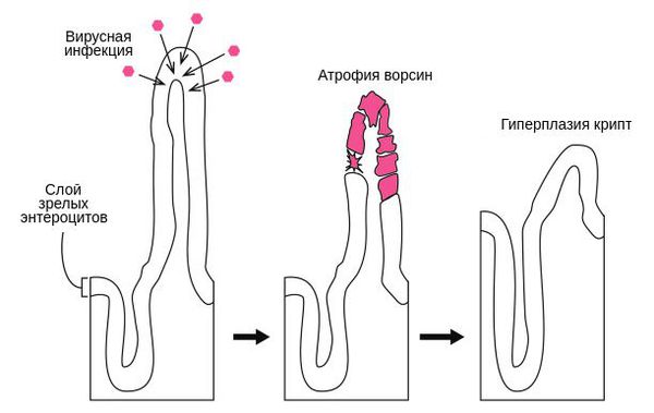 Механизм изменения строения кишечника при ротавирусе