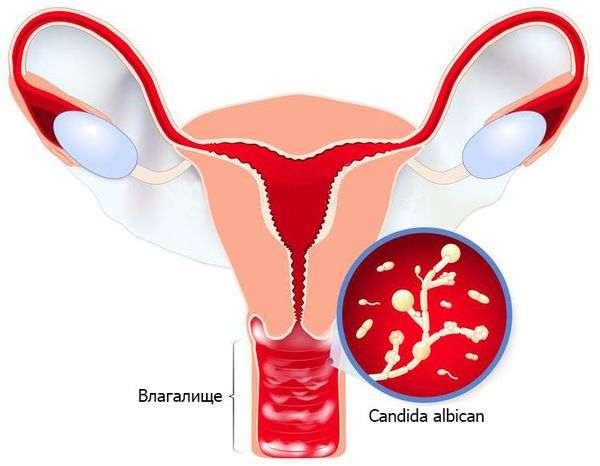 Вагинальный кандидоз