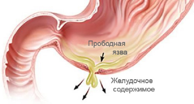 прободение язвы