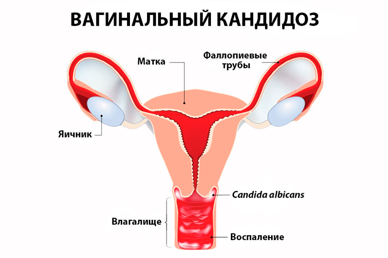 Вагинальный кандидоз