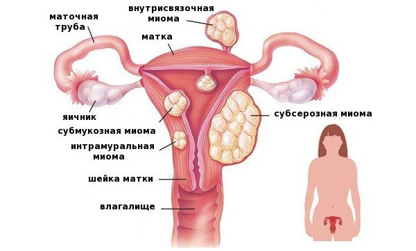 имплантационное кровотечение