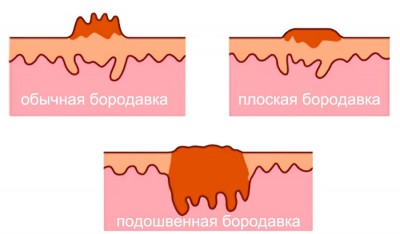 Как выглядят бородавки в разрезе