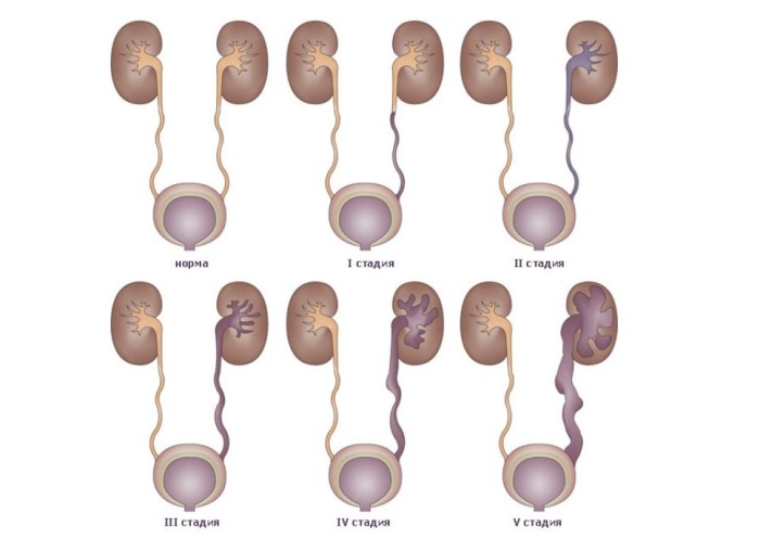 Все стадии пузырно-мочеточникового рефлюкса