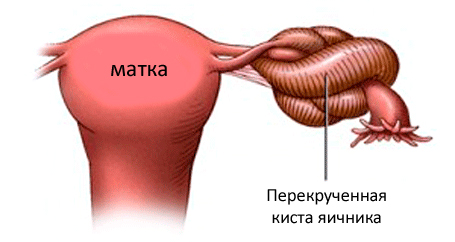 Перекрученная киста яичника