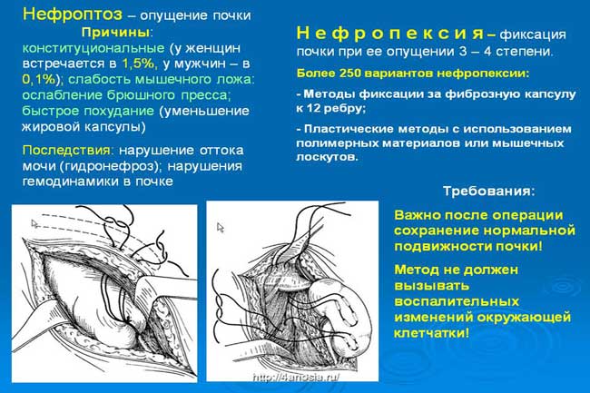 Причины нефроптоза