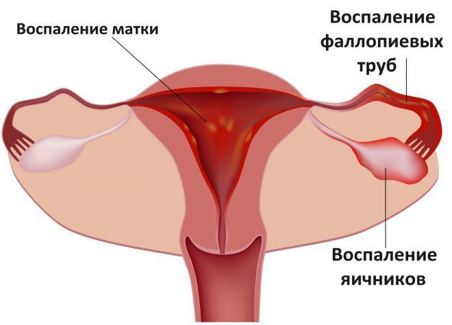 Воспалительные процессы шейки и труб матки