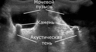 Камень в полости мочевого пузыря