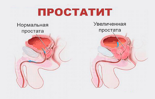 Что такое простатит?