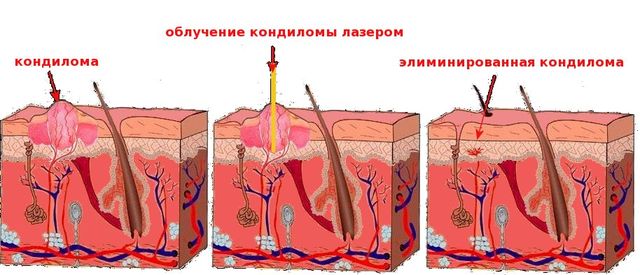 Лазерное удаление кондилом