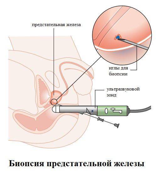 Биопсия простаты