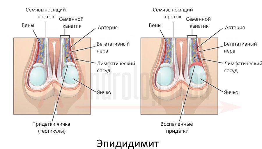 Воспаление придатка тестикулы