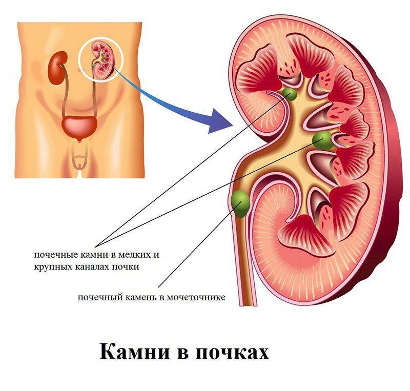 Камни в почках