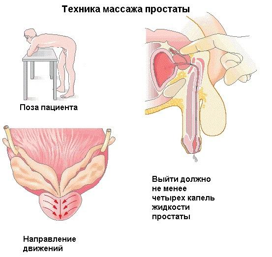 Техника массажа простаты