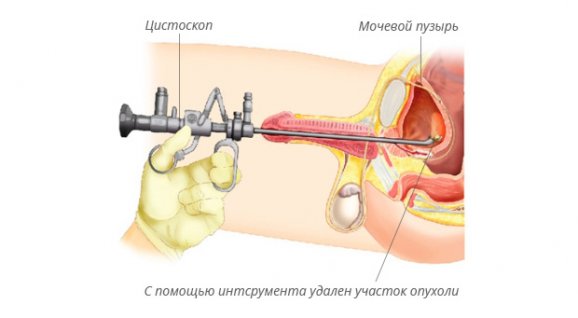 Цистоскопия