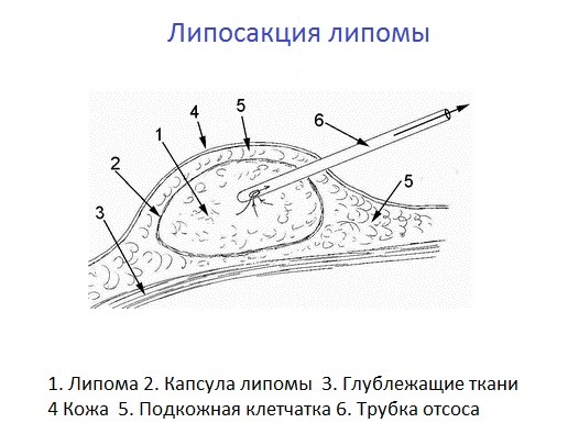 Как избавиться от жировиков на лице в домашних условиях. Причины возникновения