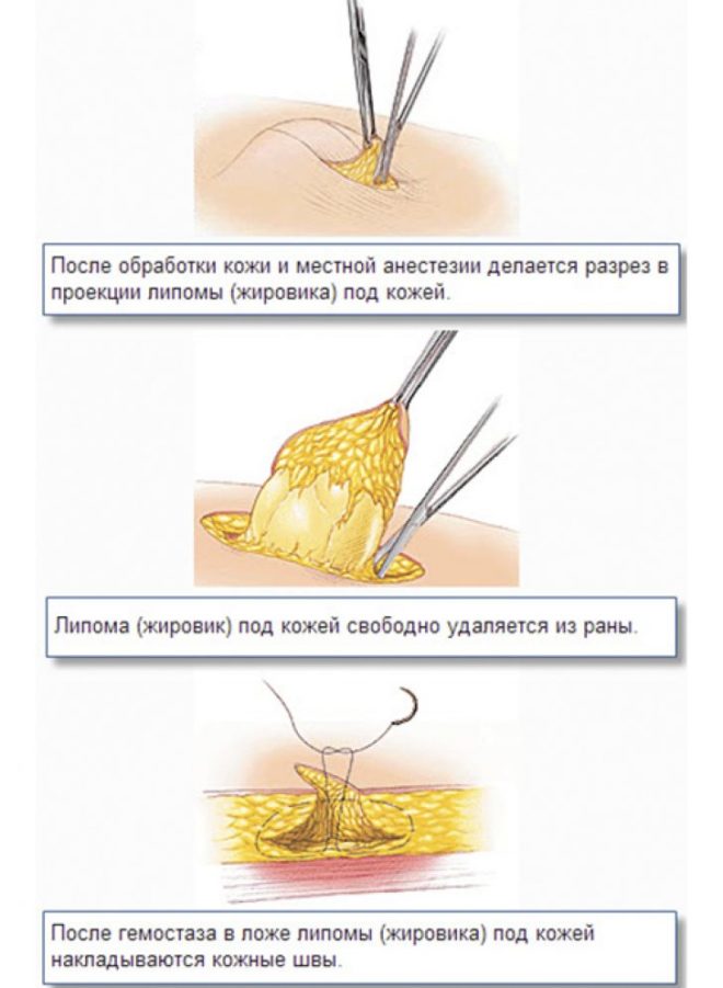 схема удаления липомы