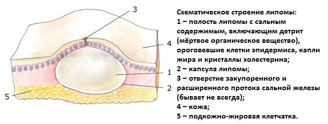 строение жировика