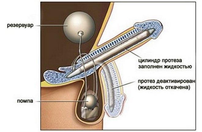 Фаллопротезирование