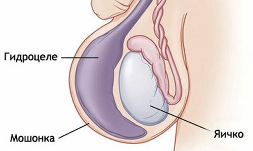 Гидроцеле - это скопление жидкости в мошонке, возникающее в раннем реабилитационном периоде после операции по удалению грыжи