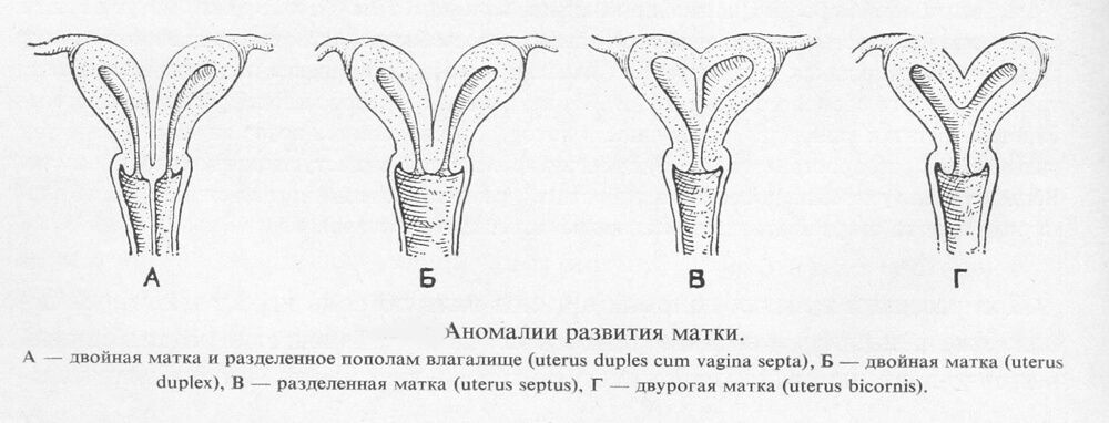 аномалии развития матки