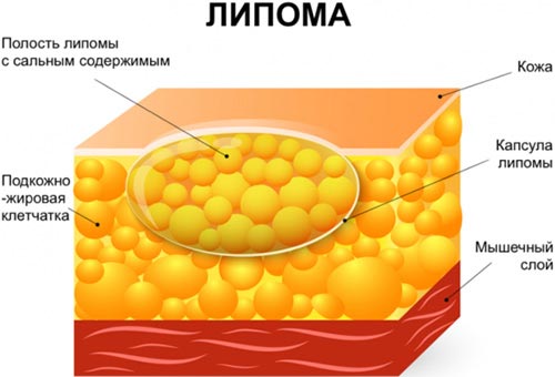 липома