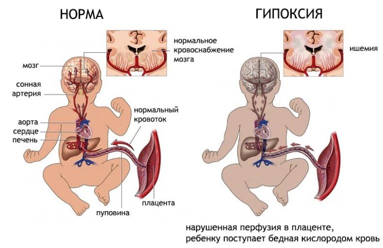 гипоксия плода симптомы и последствия