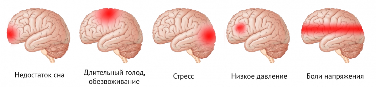 головные боли при беременности