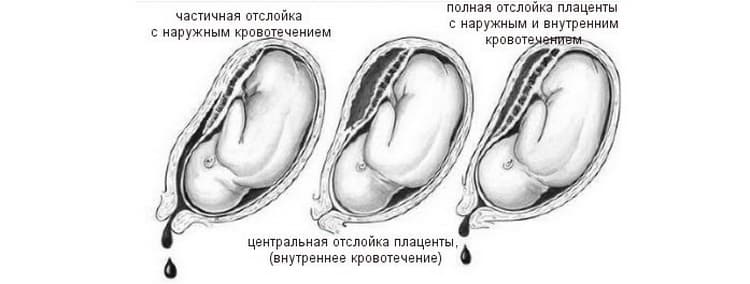 О чем могут говорить кровавые выделения при беременности на ранних сроках