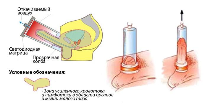 Проведение ЛОД терапии