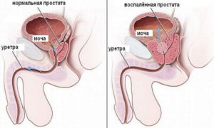 учащенное мочевыделение у мужчин