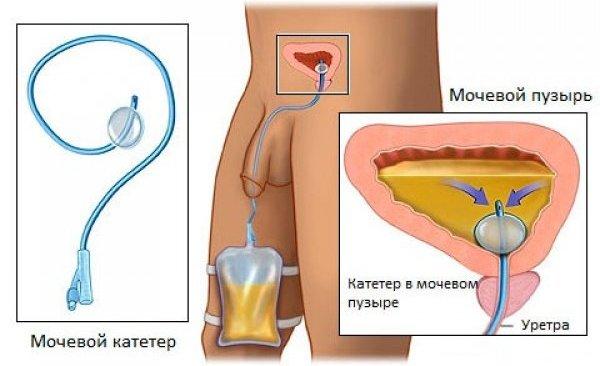 Мужской мочевой катетер