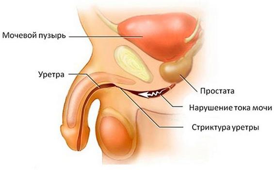 Стриктура уретры