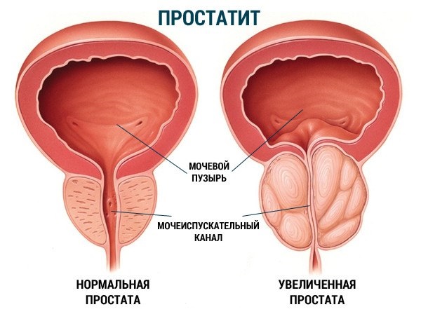 хронический простатит