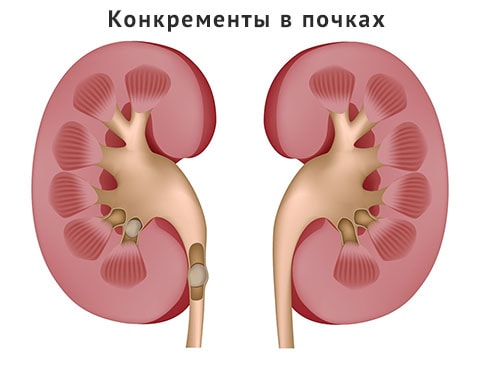 конкременты в почках 