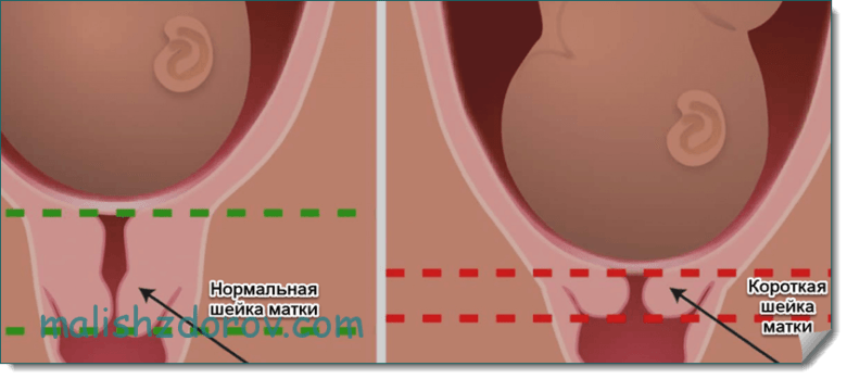 Короткая шейка матки на 16 неделе