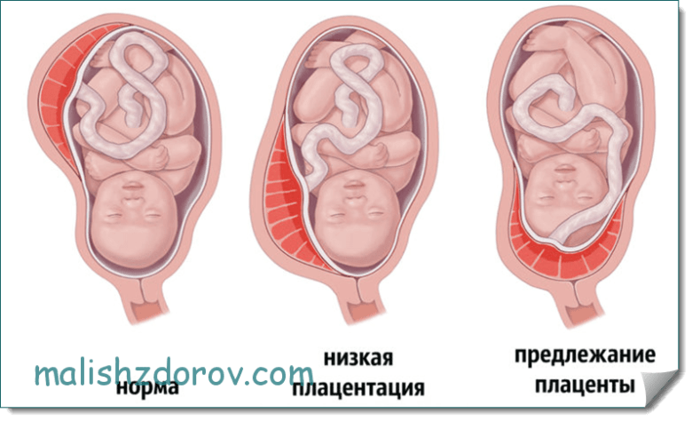 Низкая плацентация на 16 неделе