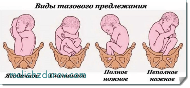 Предлежание плода 