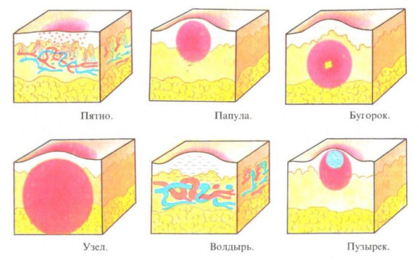 Виды кожной сыпи