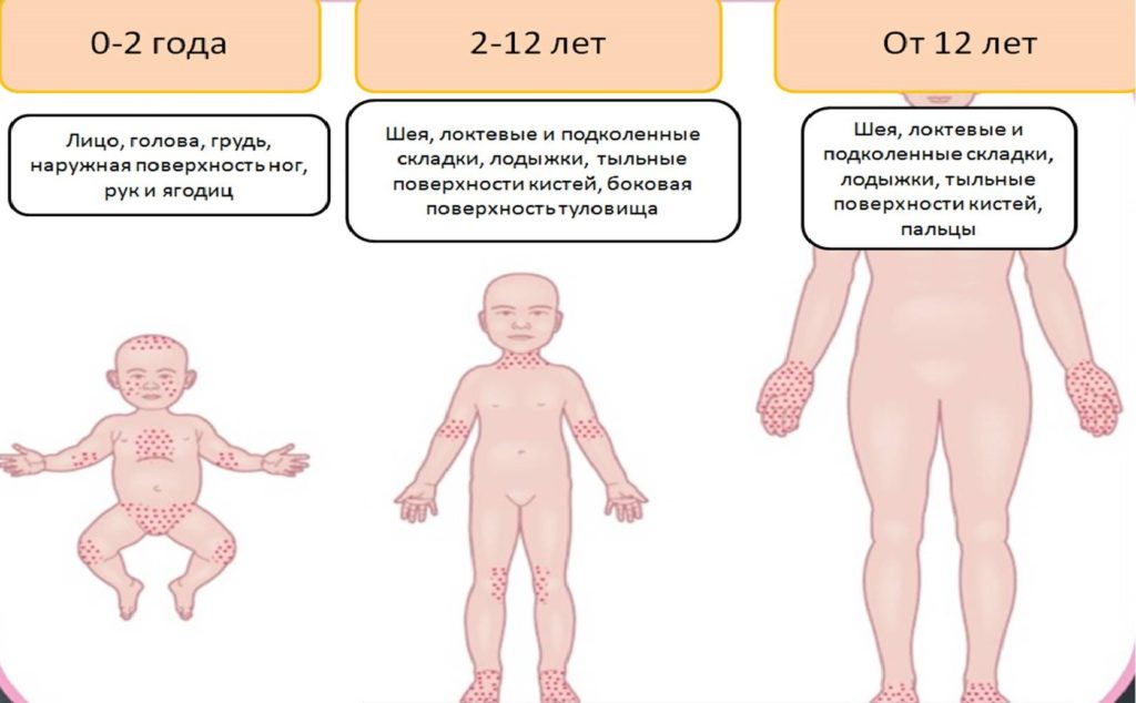 Аллергический дерматит в разном возрасте