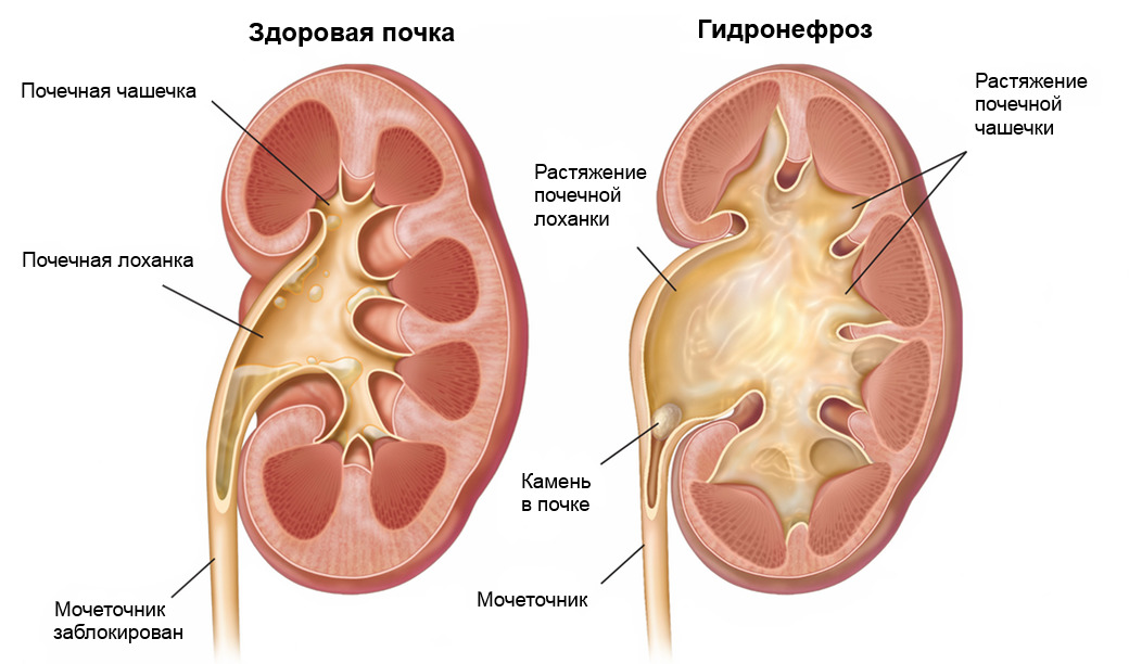 Гидронефроз