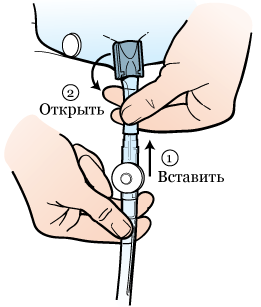 открытие мочеприемника